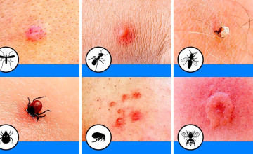 Tanuld meg felismerni ezt a 10 rovarcsípést!