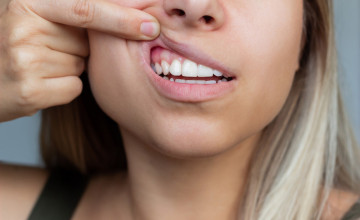 Az ínygyulladás a fogak elvesztéséhez vezethet! Így kezelhető természetes módszerekkel: