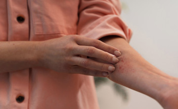 Fejfájás a vörösbortól és viszketés a paradicsomtól? Nem allergia, hanem hisztamin-túltengés