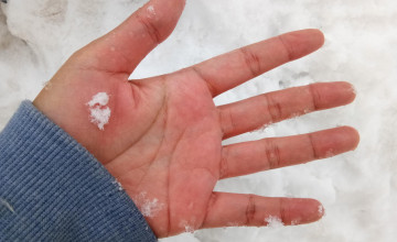 Létezik hidegallergia? Miért viszket a bőröm a hidegben?