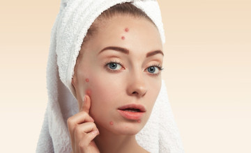 Miért nem elég kívülről kezelni a pattanásokat?