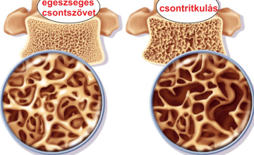 Kalciumot szedsz? Önmagában nem elég a csontritkulás megelőzésére!