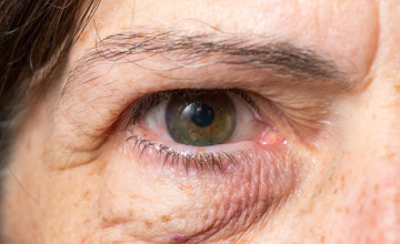 A szem alatti karikák komoly betegségeket jelezhetnek