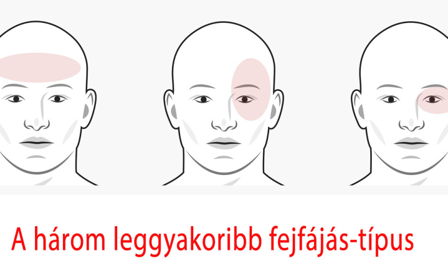 Tanuld meg megkülönböztetni! Ez a  három leggyakoribb fejfájás-típus!