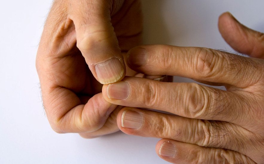 Körömgomba elleni szerek házilag