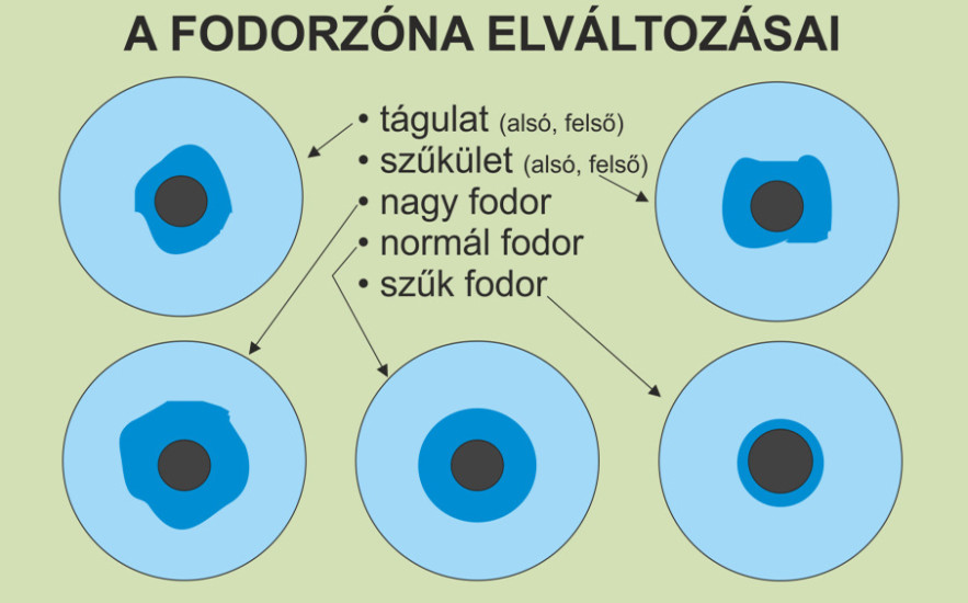 A szemed megmutatja az gyomorpanaszok okát! Az írisz elváltozásai pontosan meghatározzák a probléma helyét!