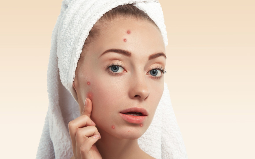 Miért nem elég kívülről kezelni a pattanásokat?